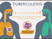 Warga Bakungan Diajak Kenali Gejala TBC Lewat Penyuluhan Kesehatan